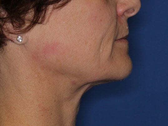 Radiofrequency Skin tightening After