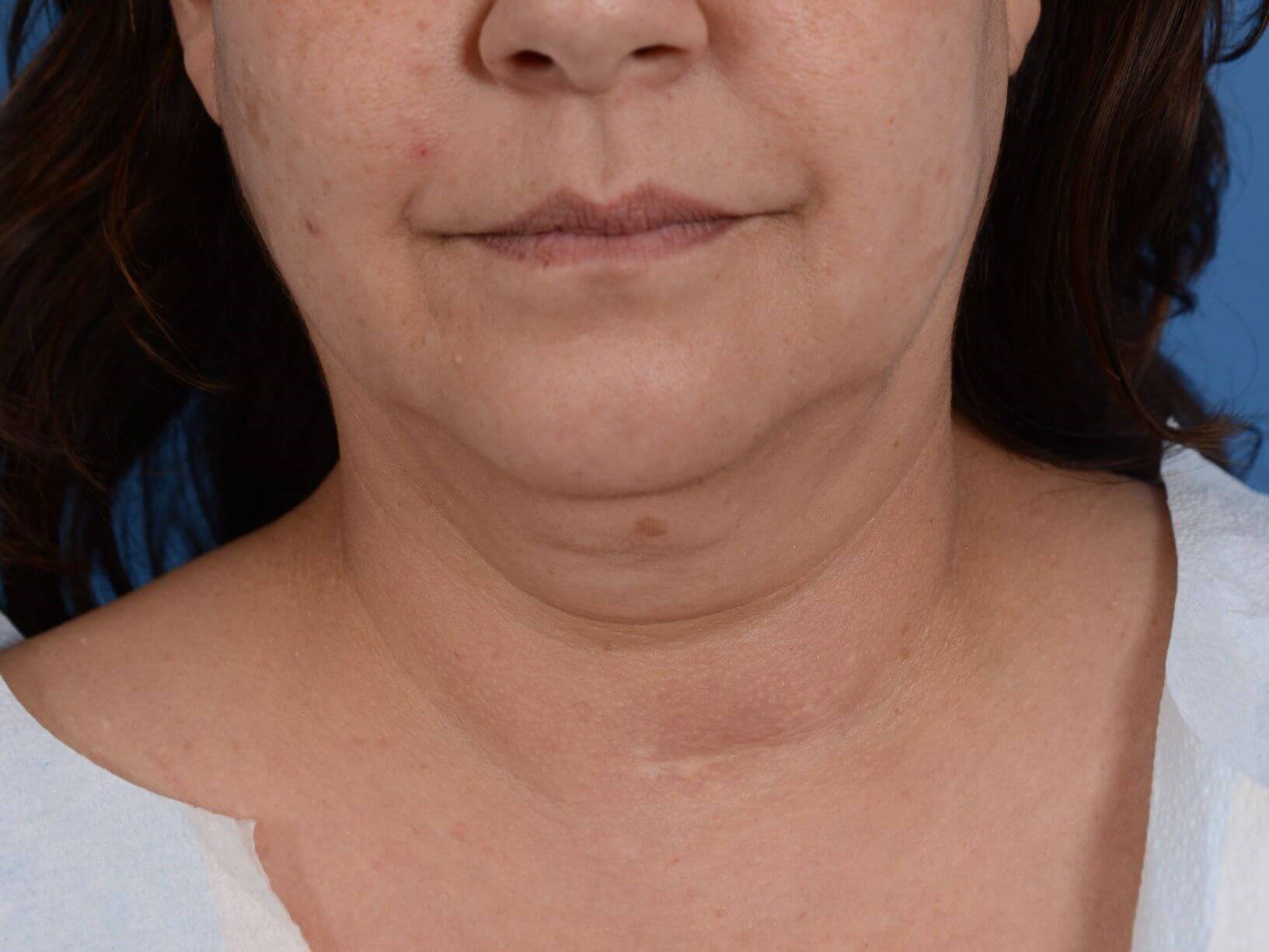 Radiofrequency Skin tightening Before