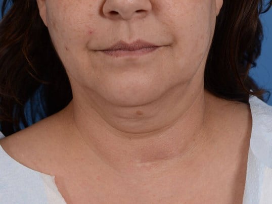 Radiofrequency Skin tightening Before