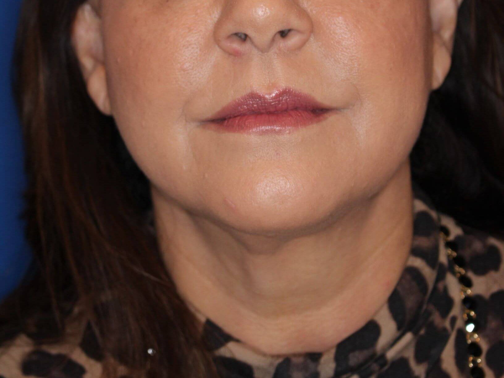 Radiofrequency Skin tightening After