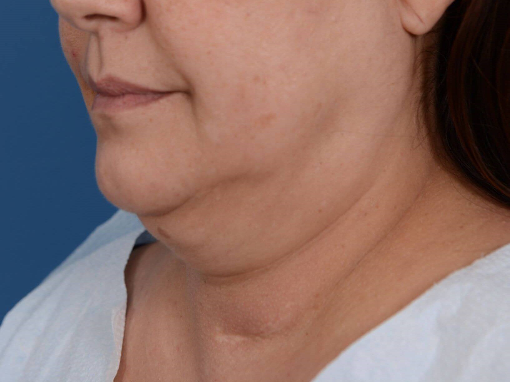 Nonsurgical Skin Tightening Before