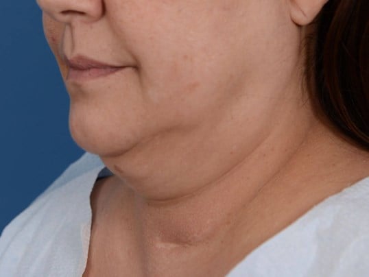 Nonsurgical Skin Tightening Before