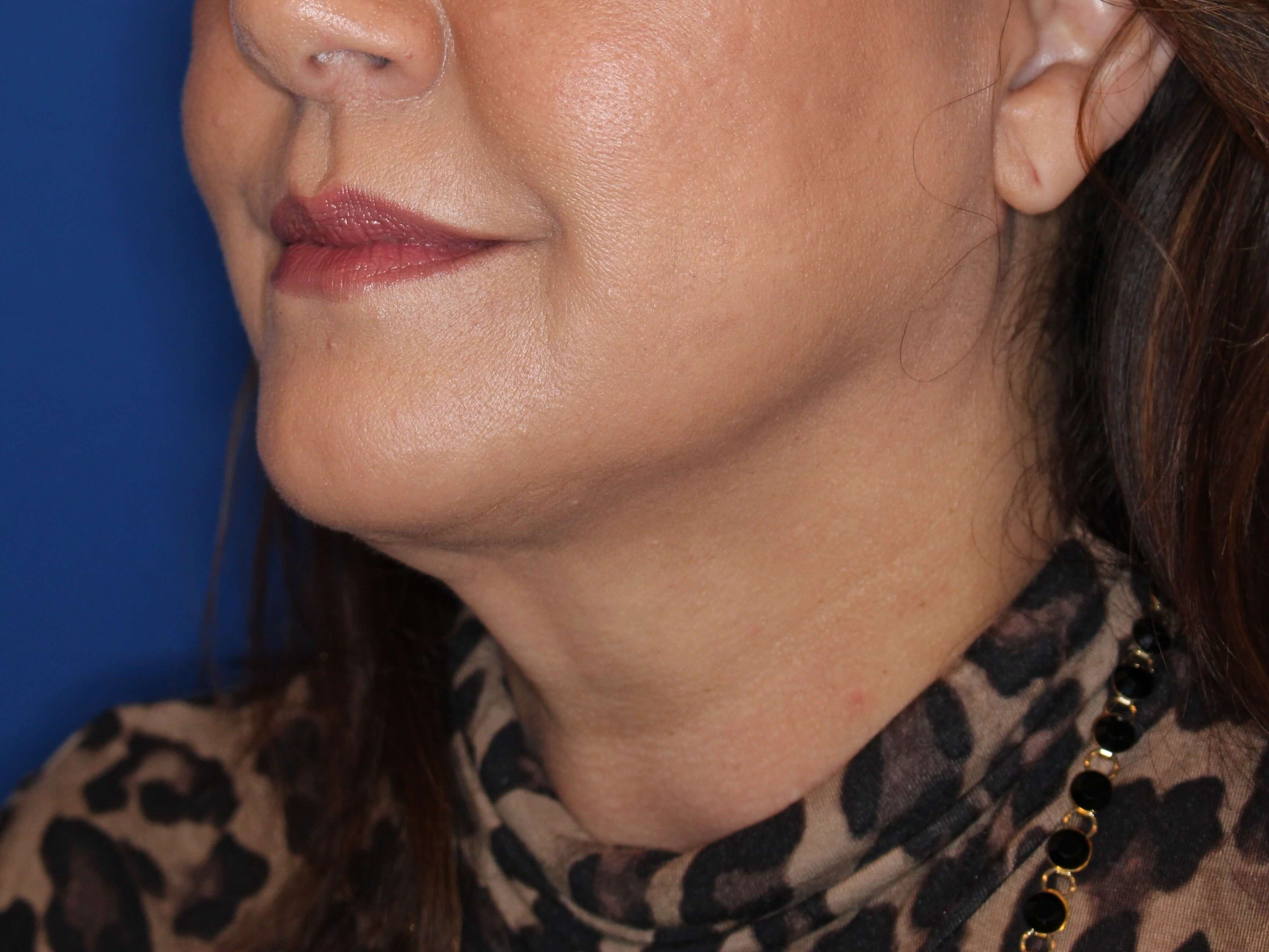 Nonsurgical Skin Tightening After