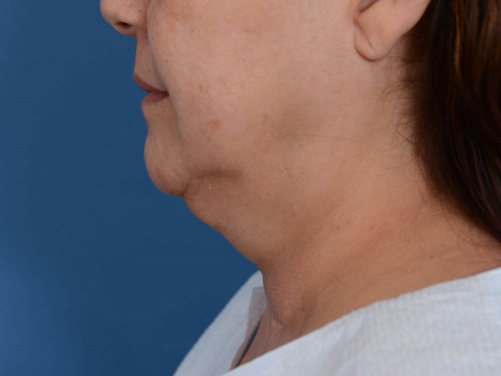 Double Chine Removal Before