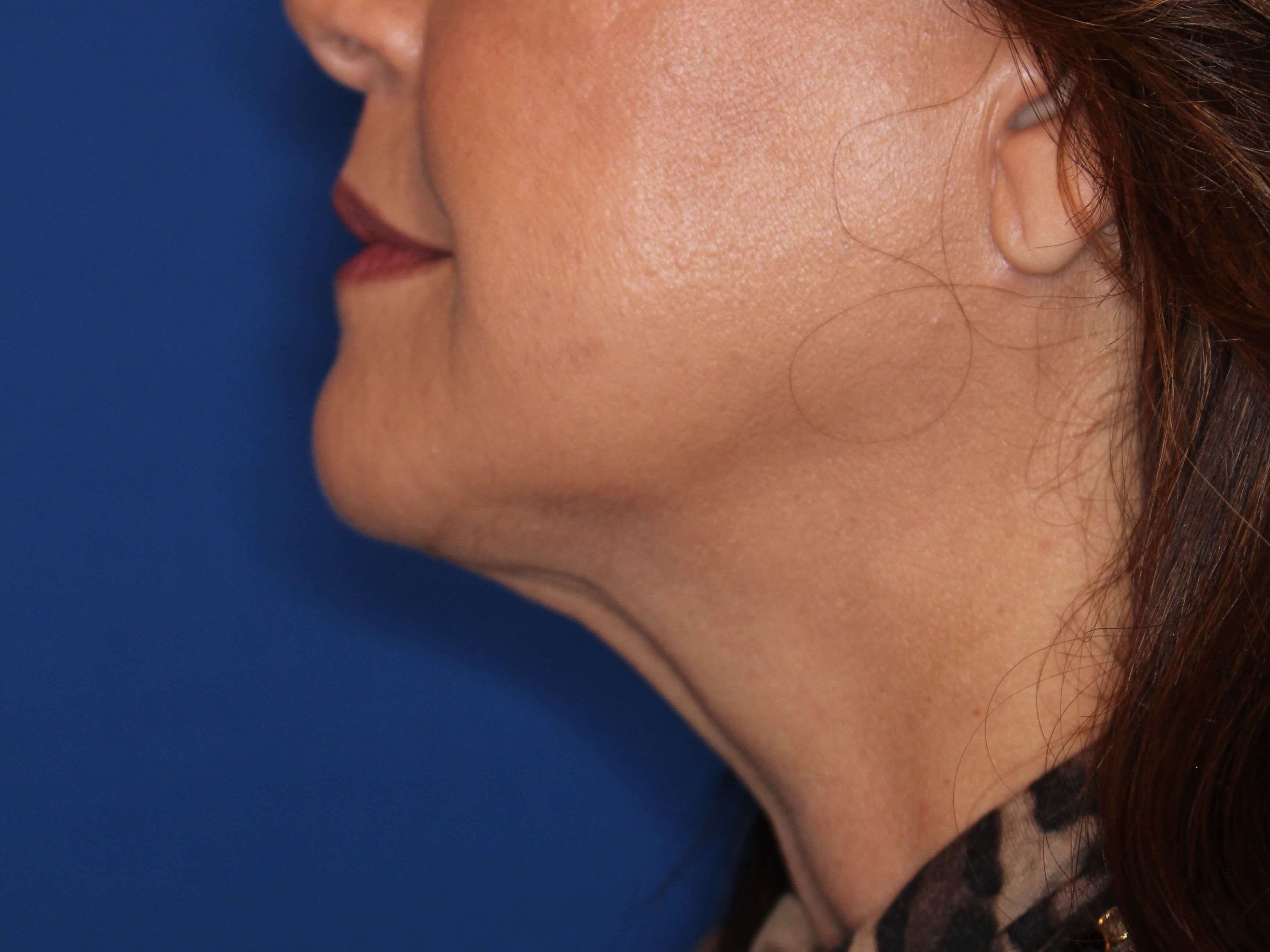 Double Chine Removal After