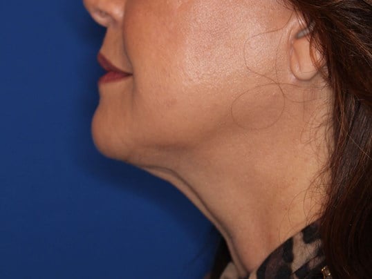 Double Chine Removal After