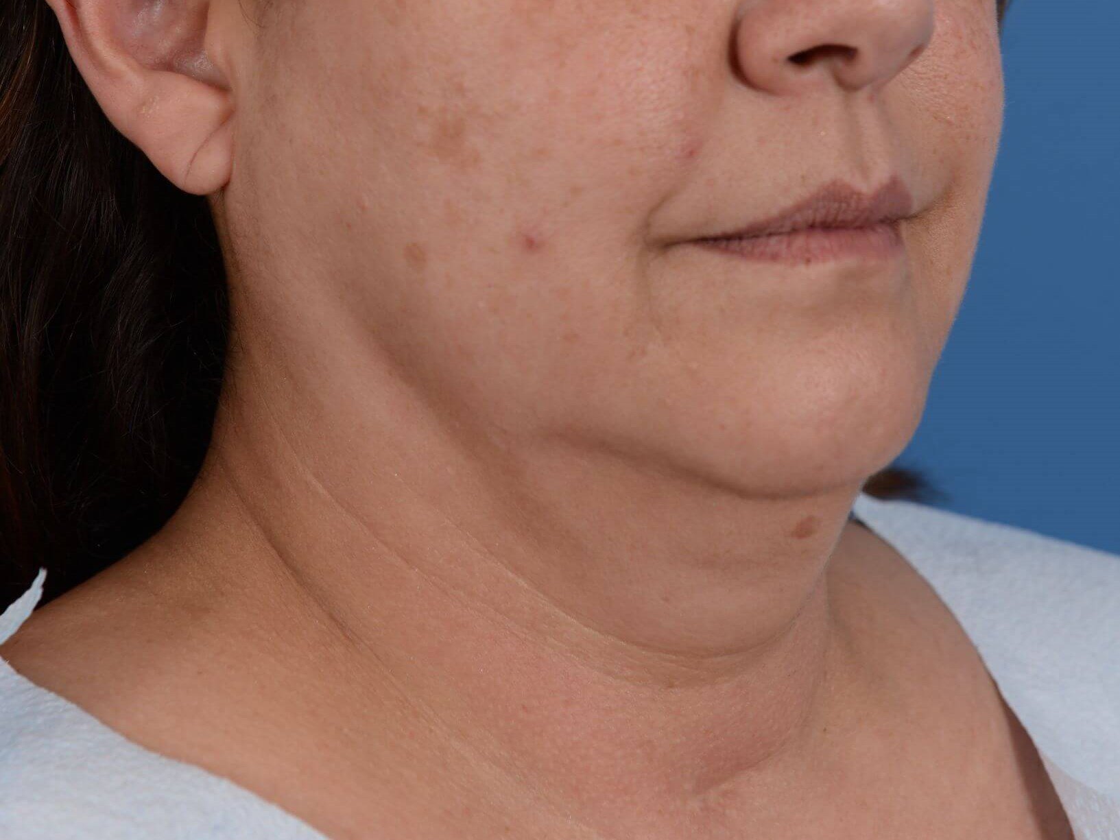 Double chin removal Before