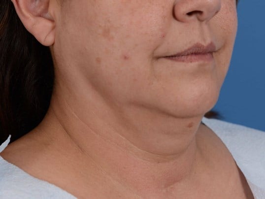 Double chin removal Before