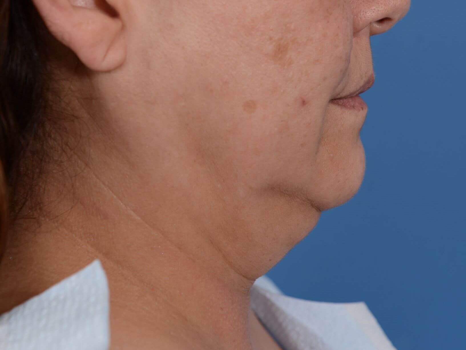Double Chin Removal Before