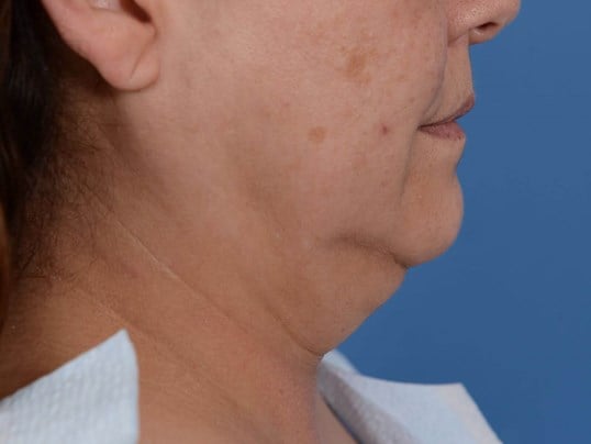Double Chin Removal Before