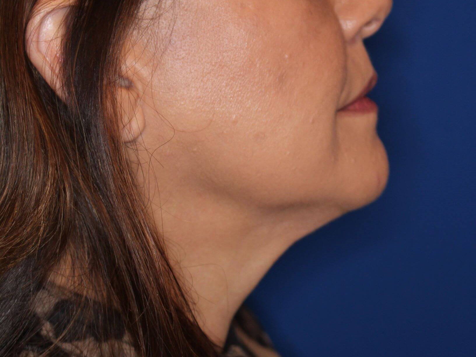 Double Chin Removal After