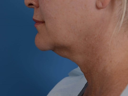 Double Chin Removal Before