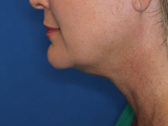 Double Chin Removal After