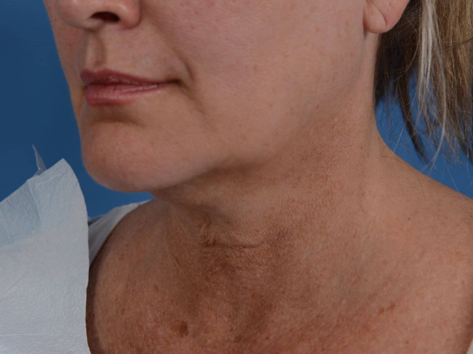 Double Chin Removal Before