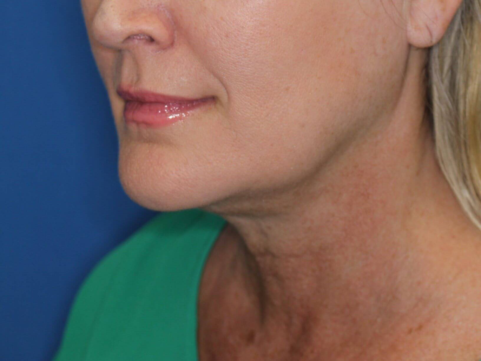 Double Chin Removal After