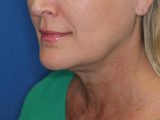 Double Chin Removal After