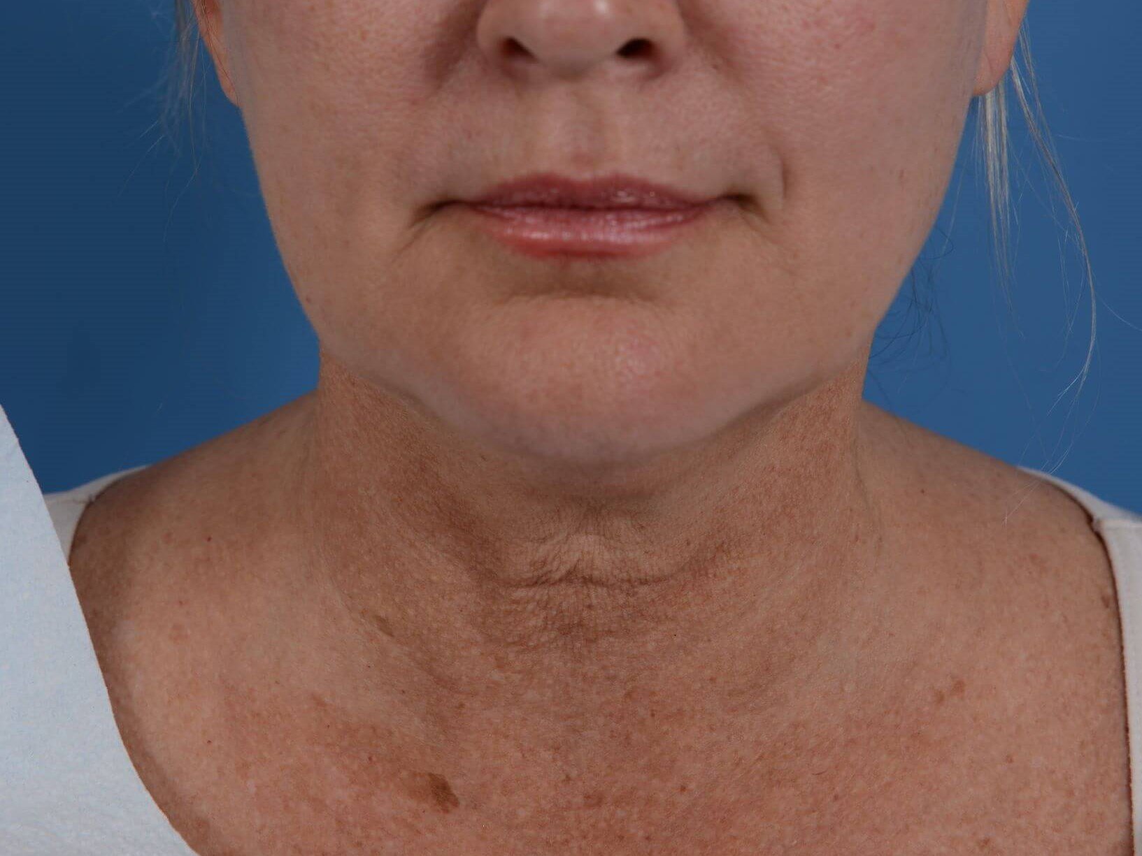 Double Chin Removal Before