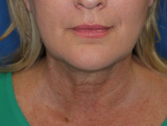 Double Chin Removal After