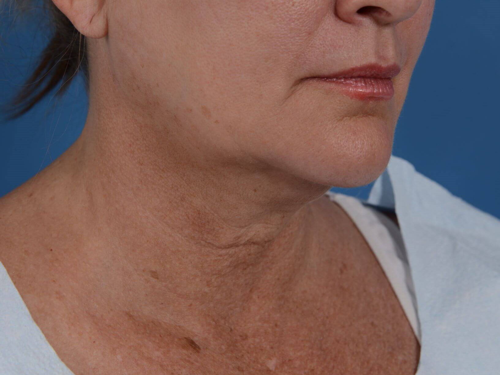 Double Chin Removal Before