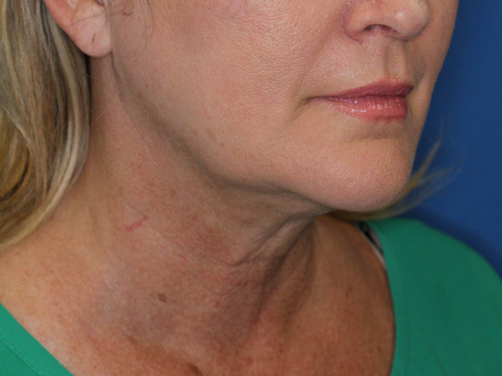 Double Chin Removal After