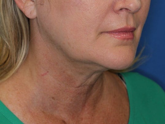 Double Chin Removal After