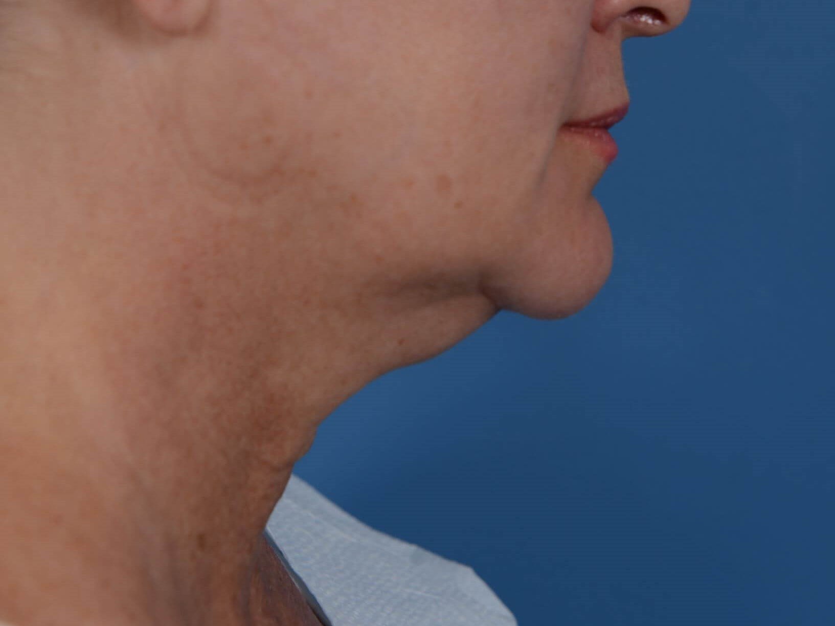 Double Chin Removal Before