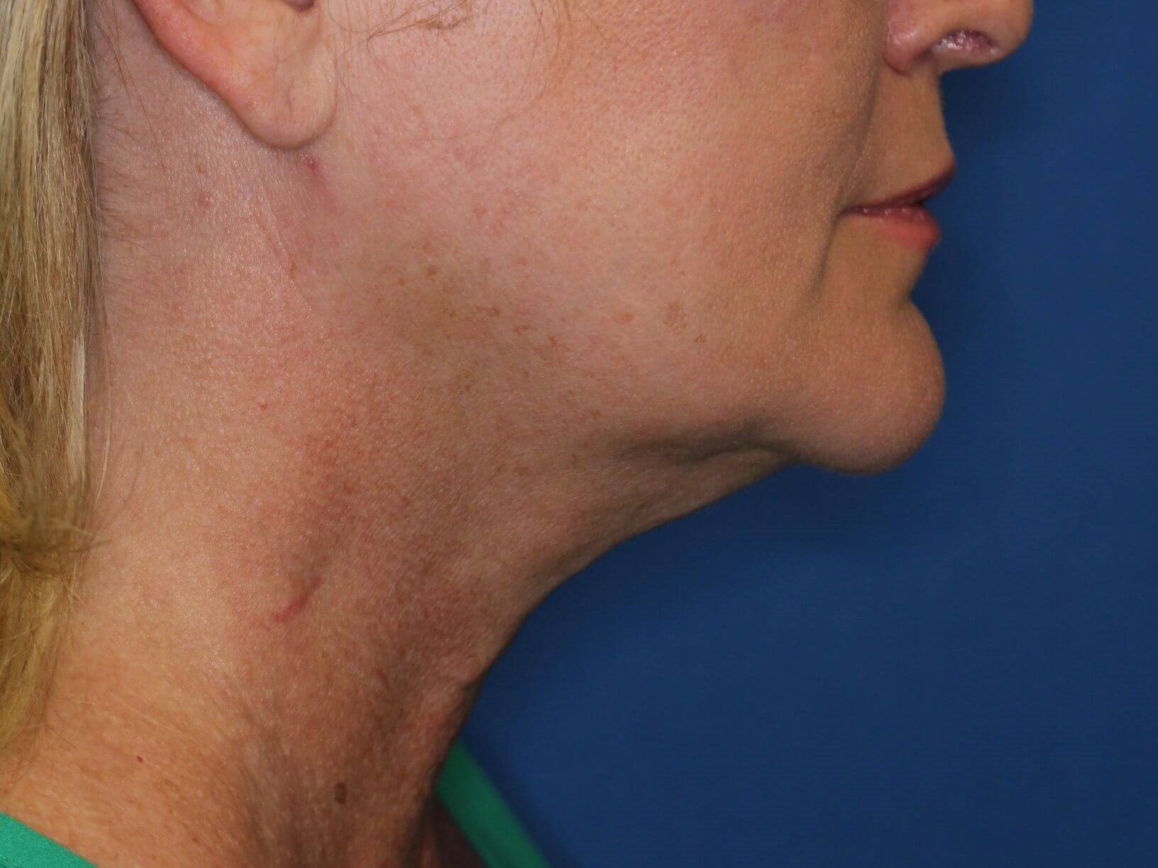 Double Chin Removal After