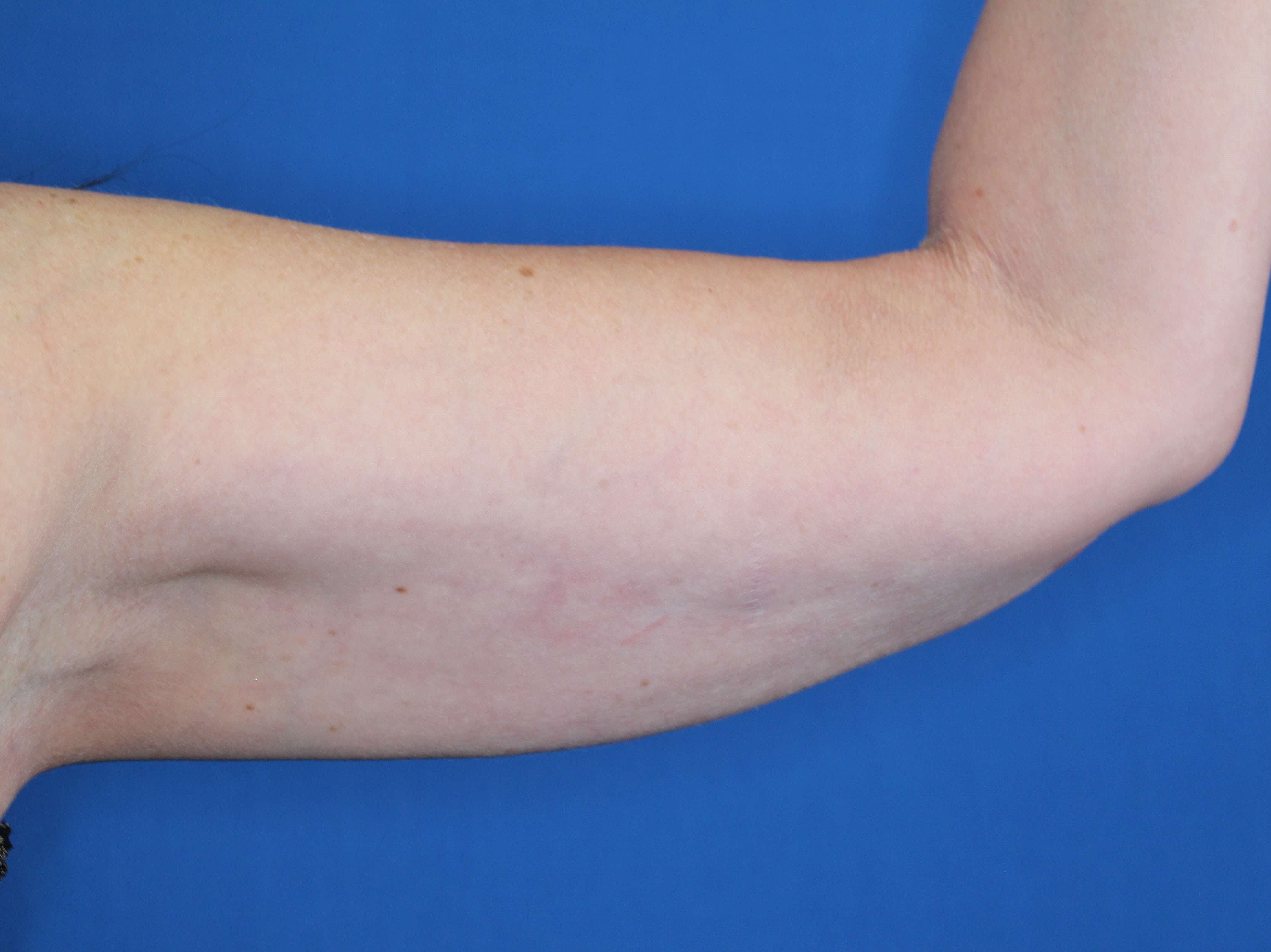 Nonsurgical Skin Tightening After