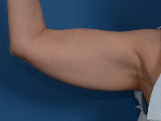 Nonsurgical Skin Tightening Before