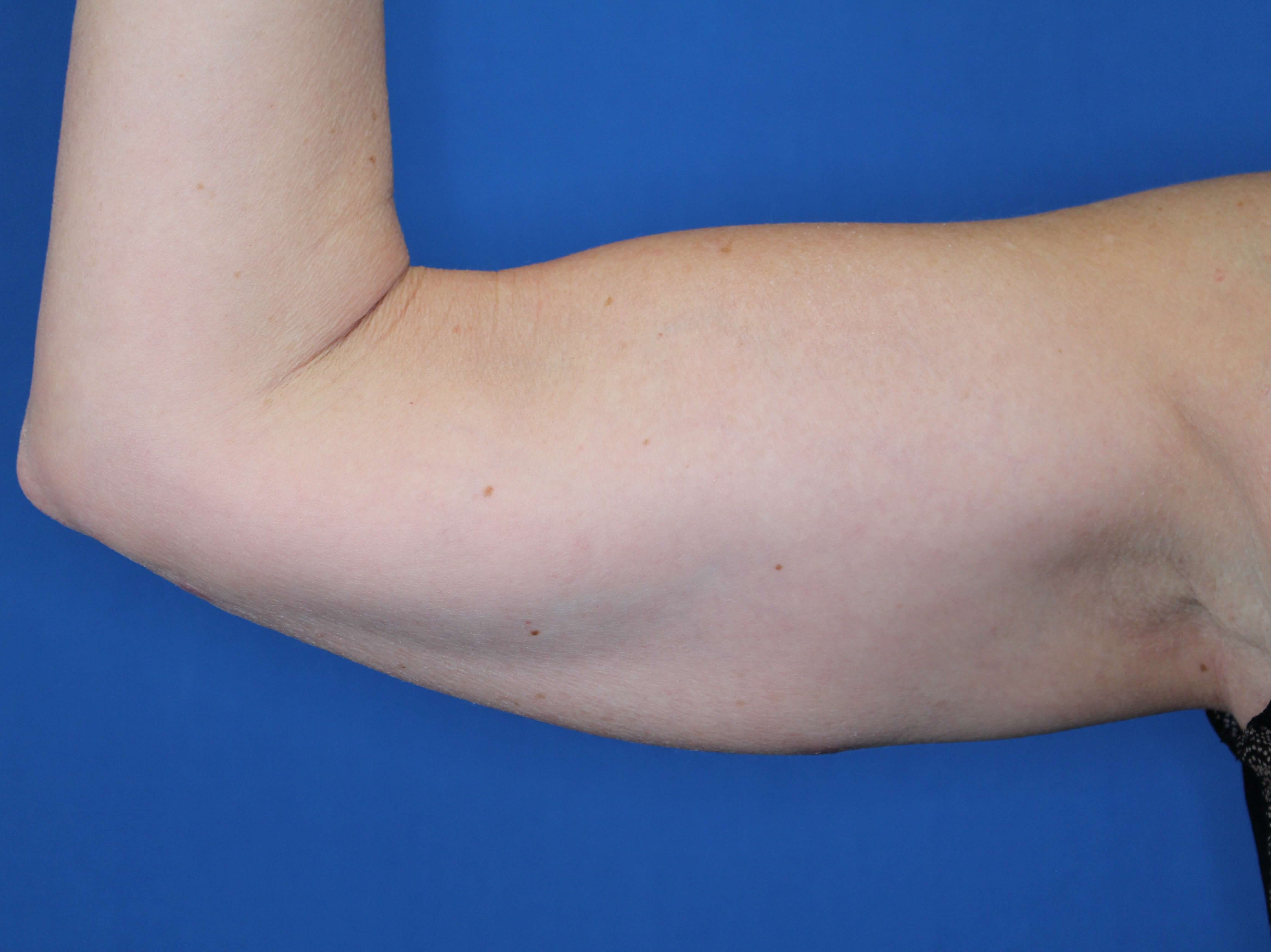 Nonsurgical Skin Tightening After