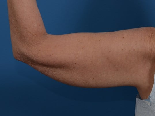 Nonsurgical Skin Tightening Before