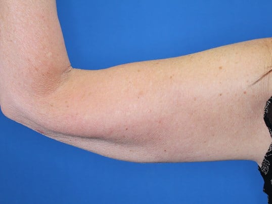 Nonsurgical Skin Tightening After