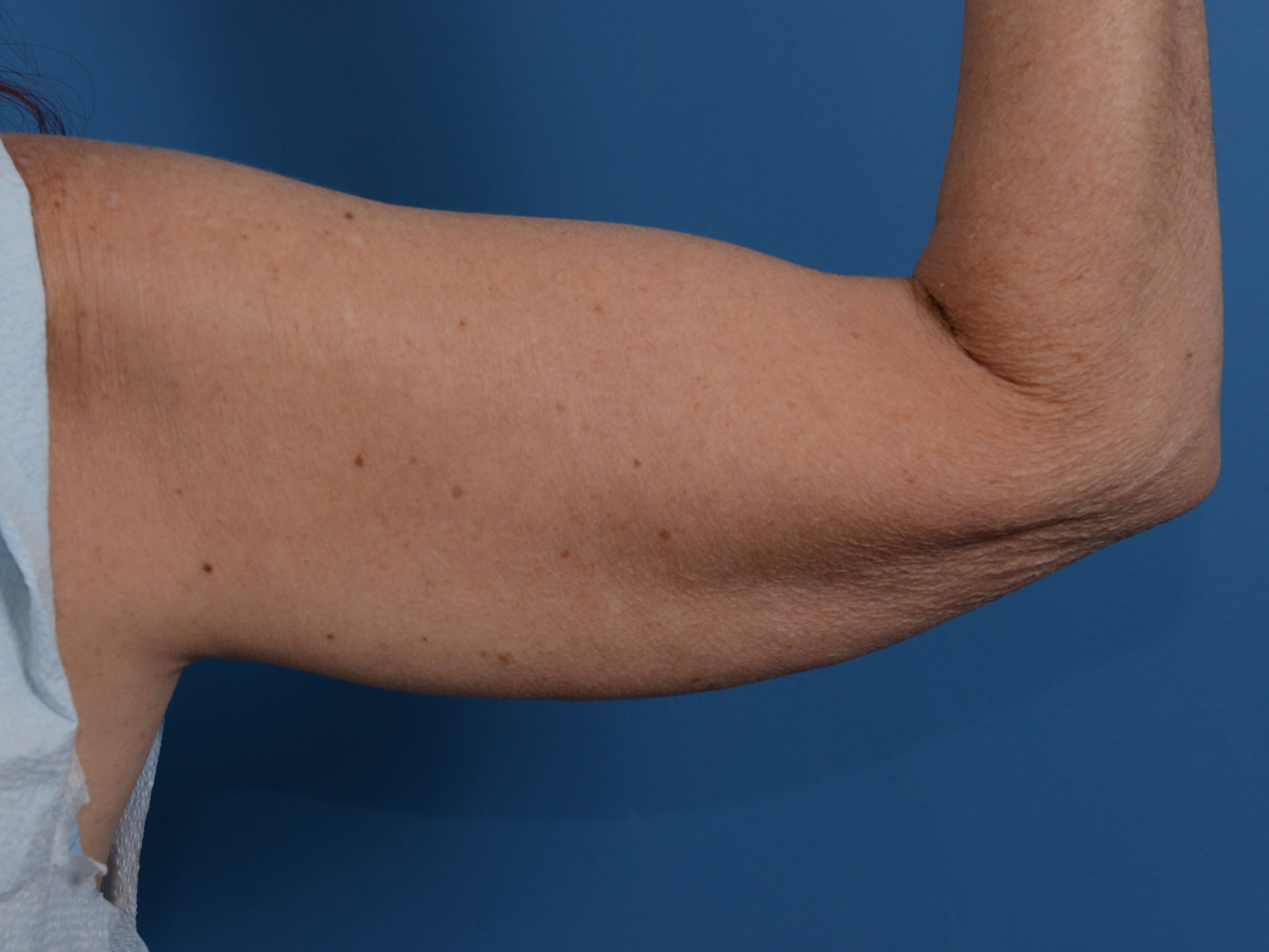 Nonsurgical Skin Tightening Before