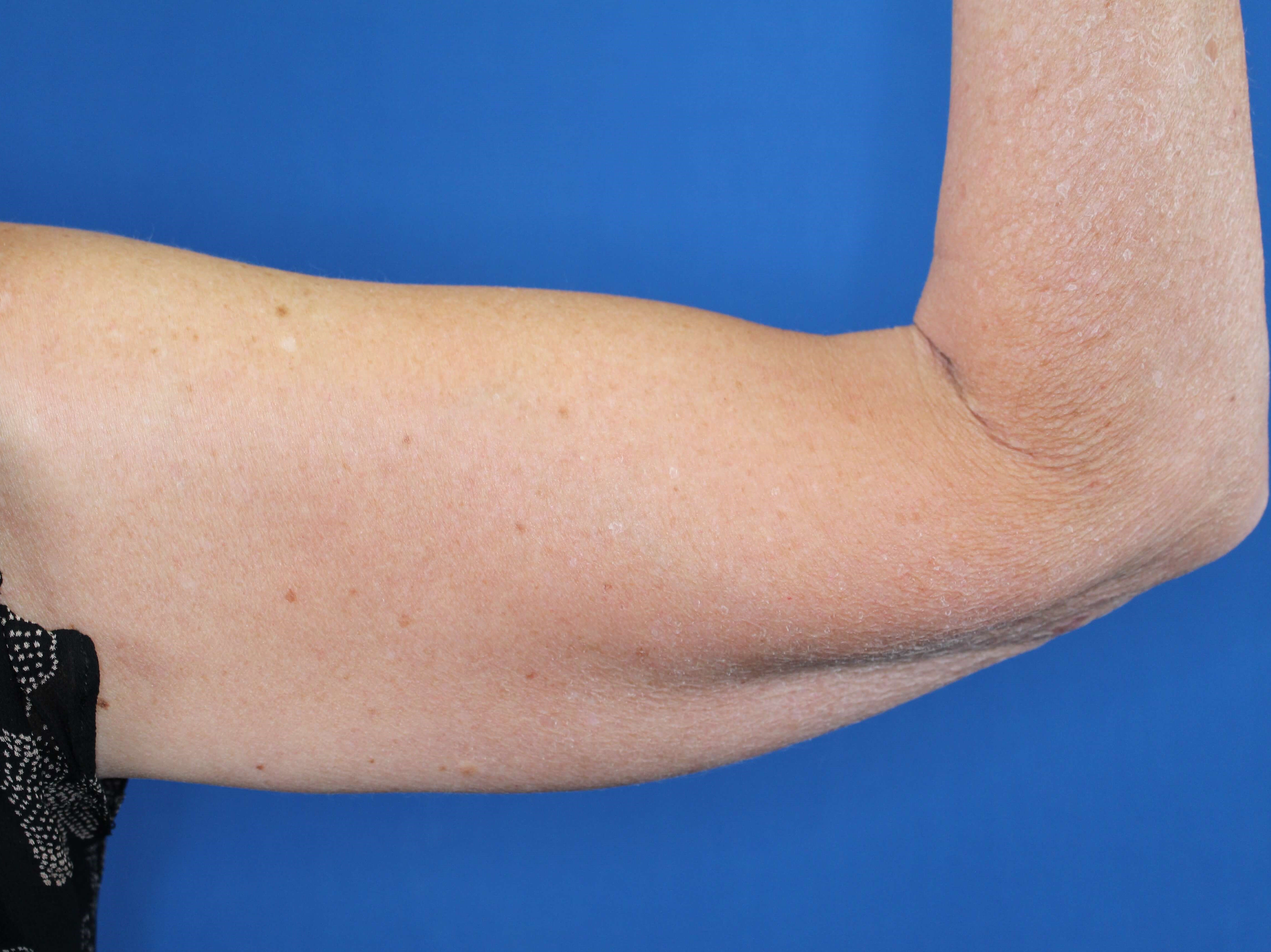 Nonsurgical Skin Tightening After