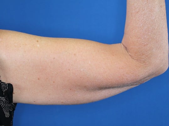 Nonsurgical Skin Tightening After