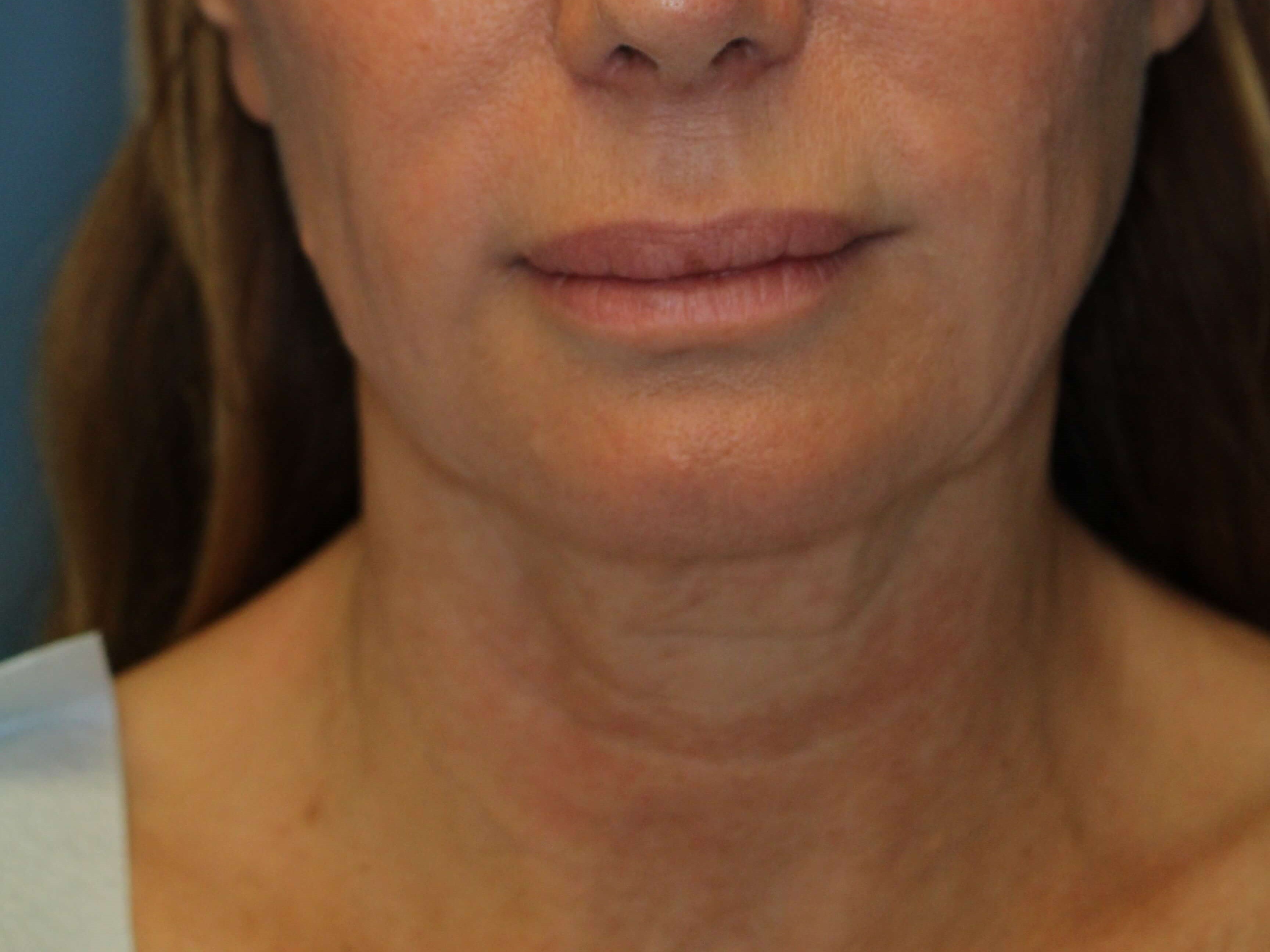 Radiofrequency Skin tightening Before