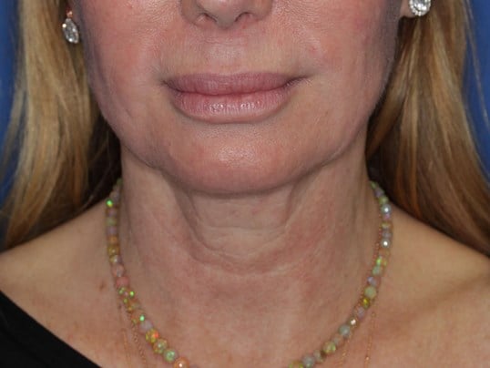 Radiofrequency Skin tightening After