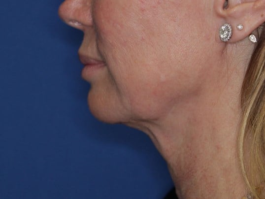 Radiofrequency Skin tightening After