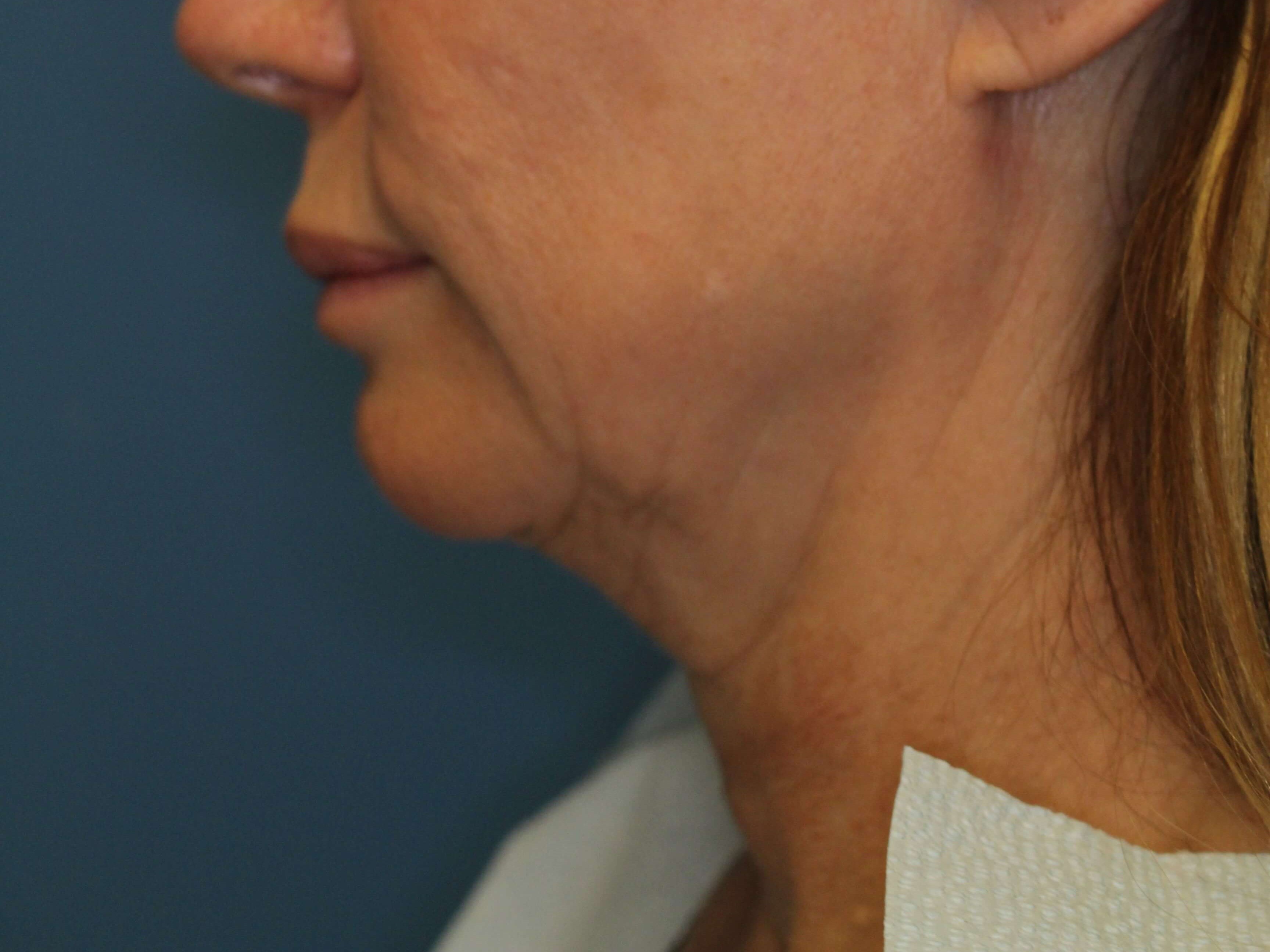 Radiofrequency Skin tightening Before