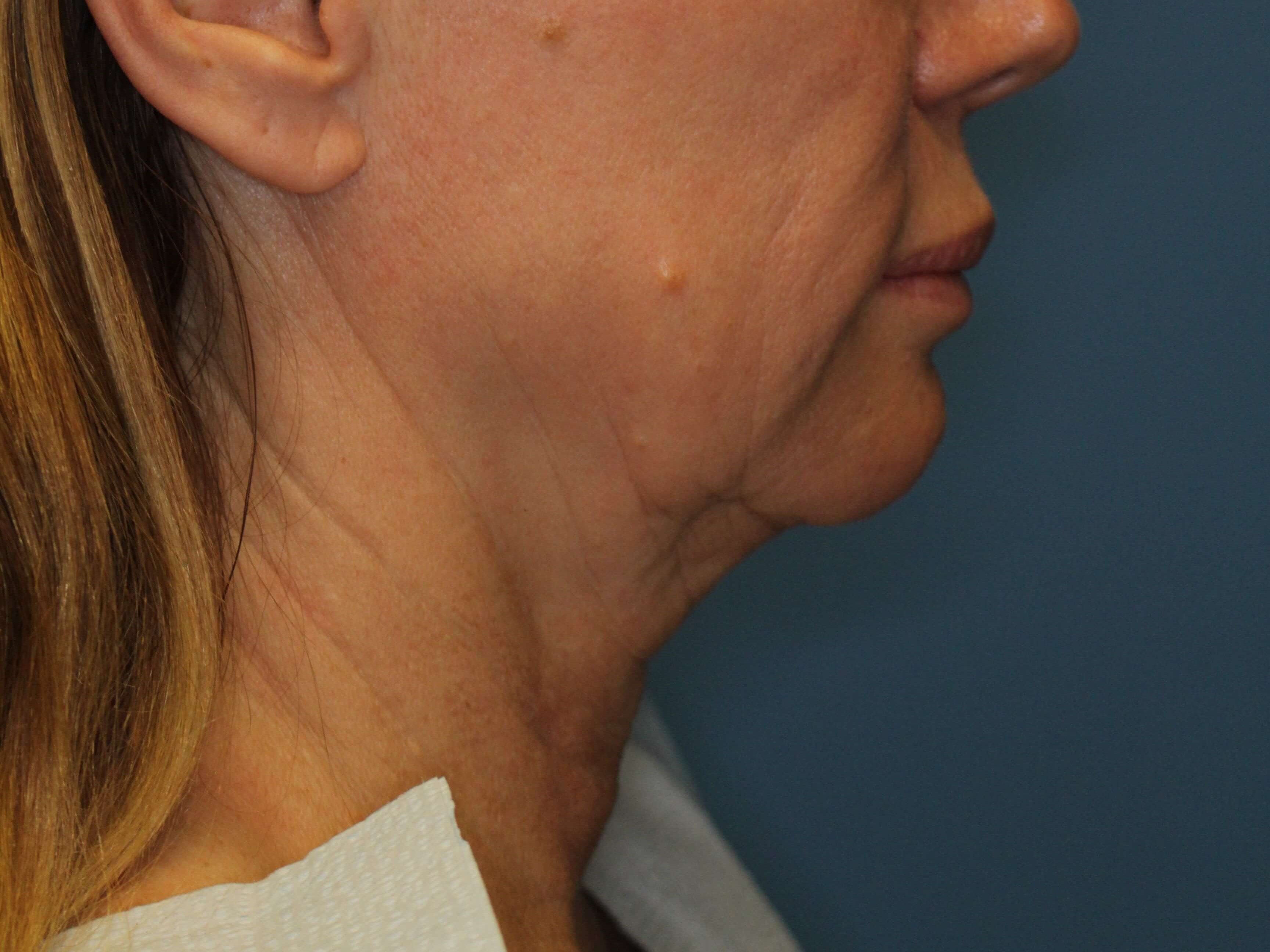 Radiofrequency Skin tightening Before