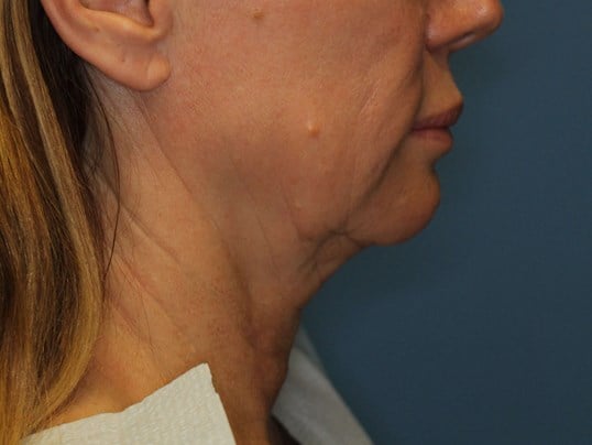 Radiofrequency Skin tightening Before