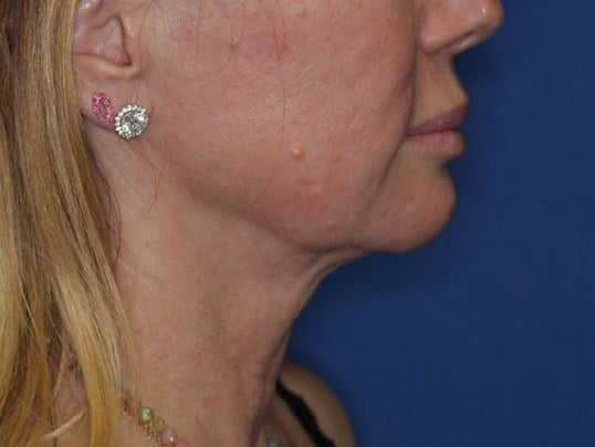 Radiofrequency Skin tightening After