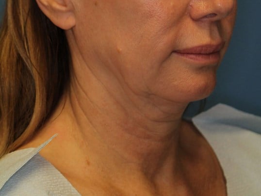 Radiofrequency Skin tightening Before