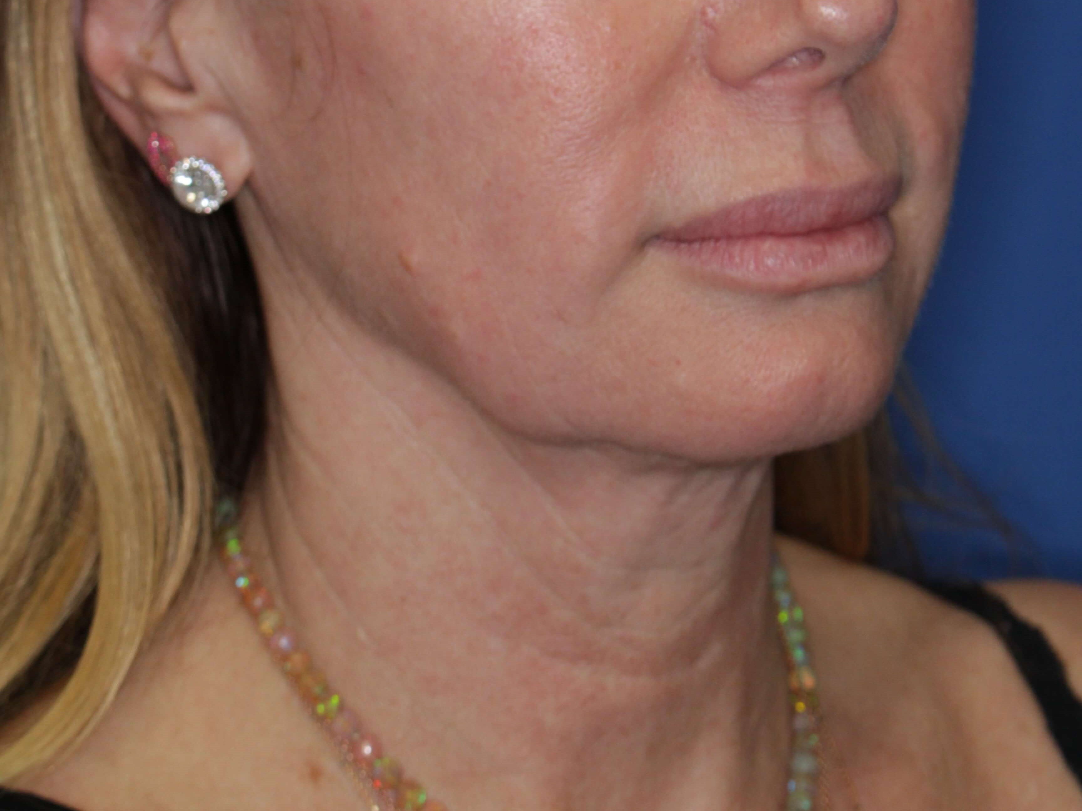 Radiofrequency Skin tightening After