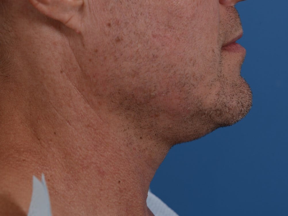 Nonsurgical Skin Tightening Before