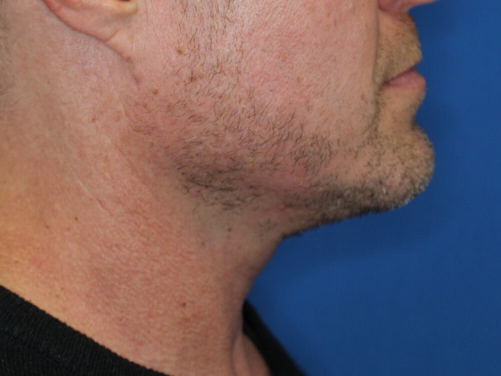 Nonsurgical Skin Tightening After