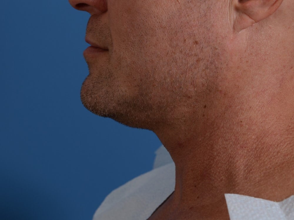 Radiofrequency Skin tightening Before