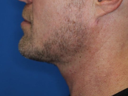 Radiofrequency Skin tightening After
