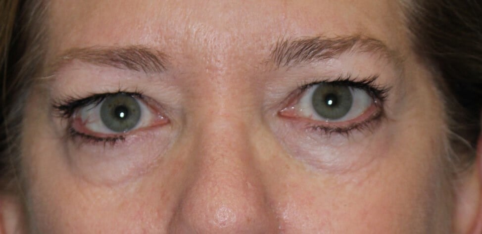 Upper Eyelid Lift Before