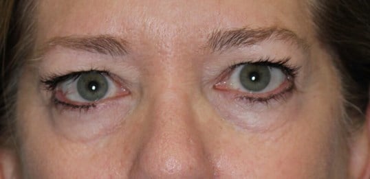 Upper Eyelid Lift Before